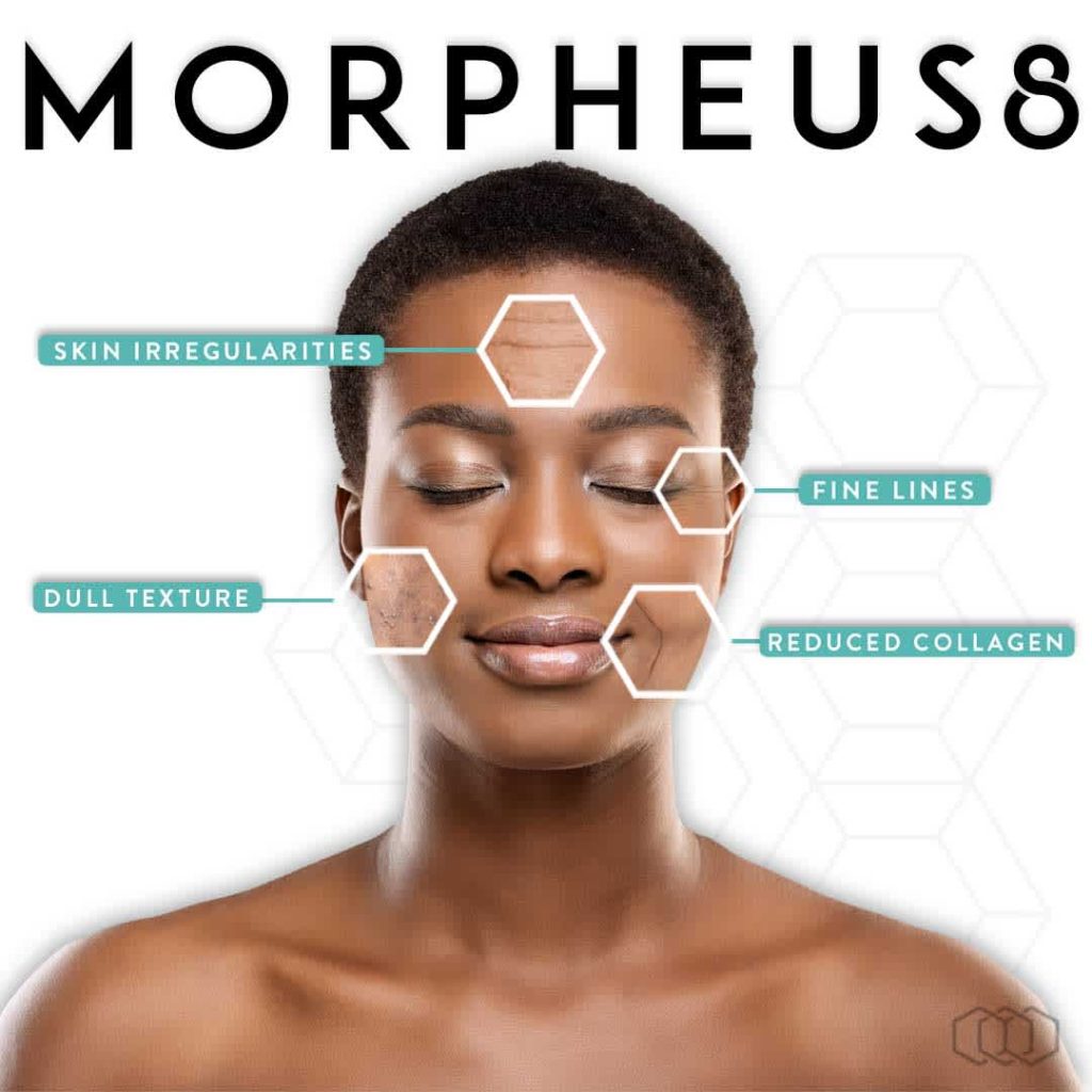morpheus8 infographic instagram post black hair preview 1