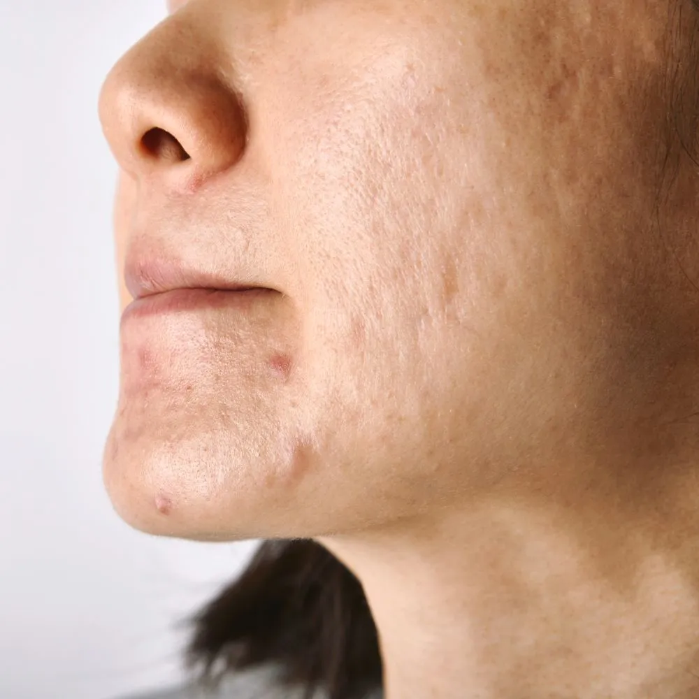 Acne Scar Support