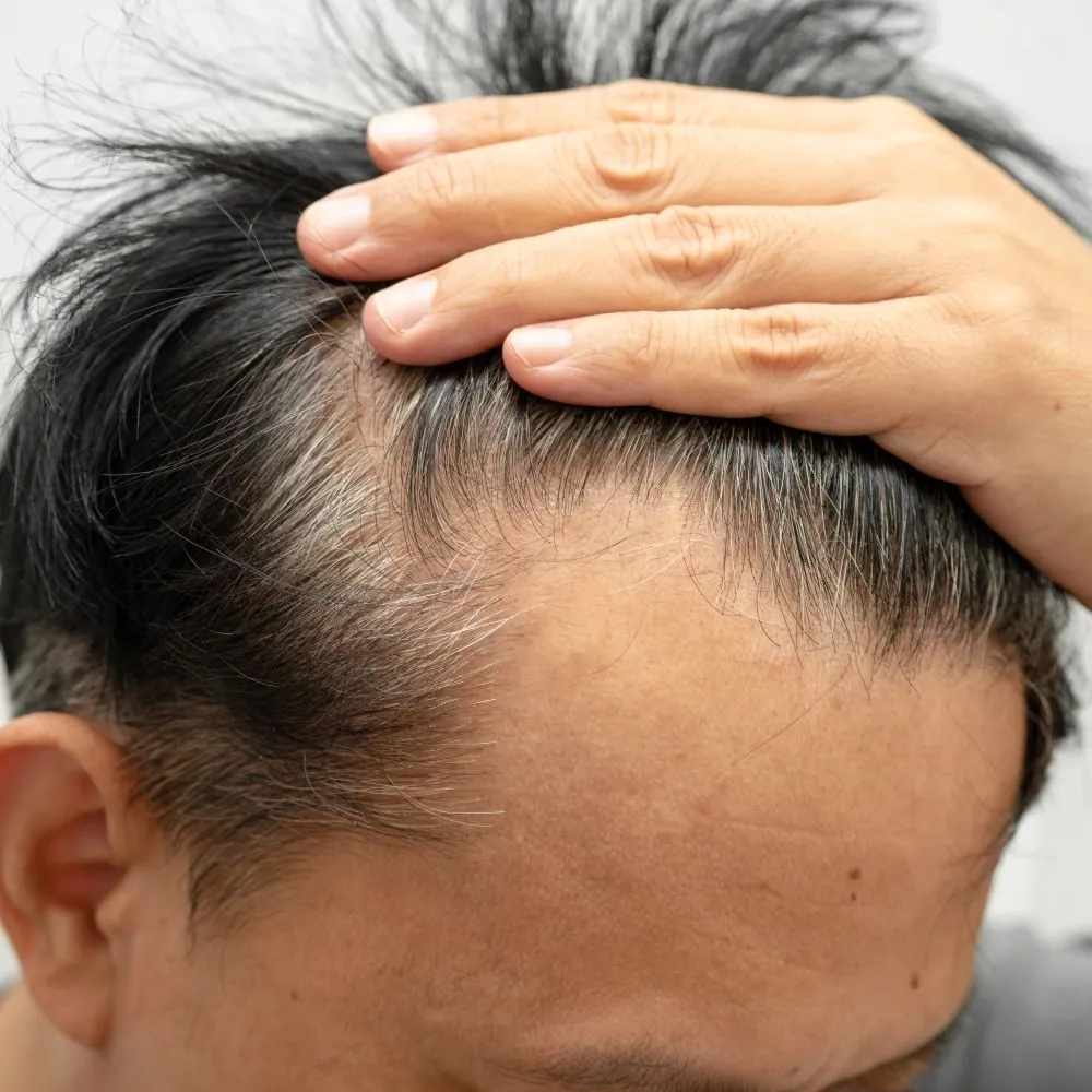 Hair Thinning
